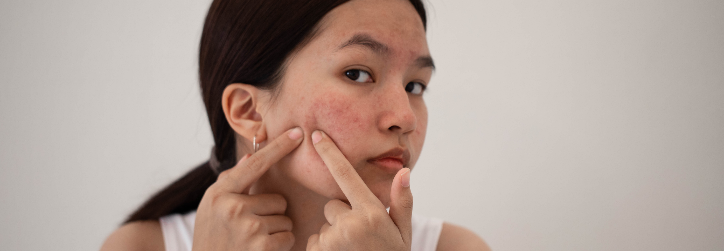 What Causes Teen Acne (and What Actually Helps)